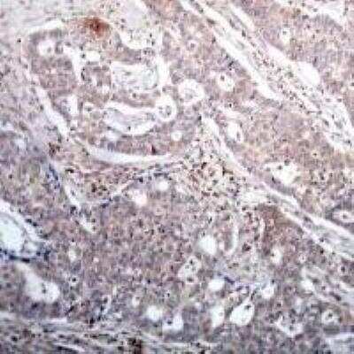 Immunohistochemistry: IkB-beta [p Ser23] Antibody [NBP2-54761] - Immunohistochemical analysis of paraffin-embedded human breast carcinoma tissue using IkappaB-B [P-Ser23].